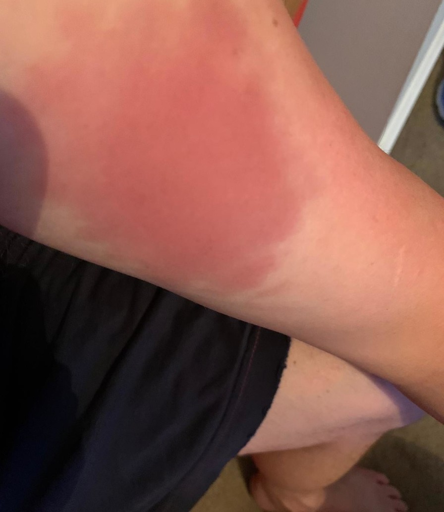 Robbie MacNab - Channel Swim bruise